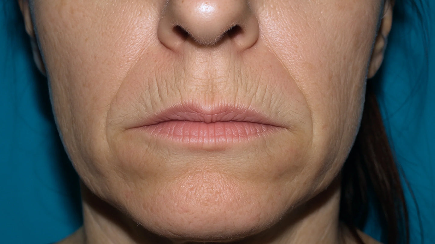 OriLip Terapi™| Çizgi Bakımı