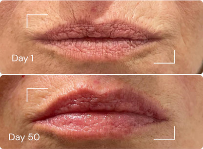 OriLip Terapi™| Çizgi Bakımı